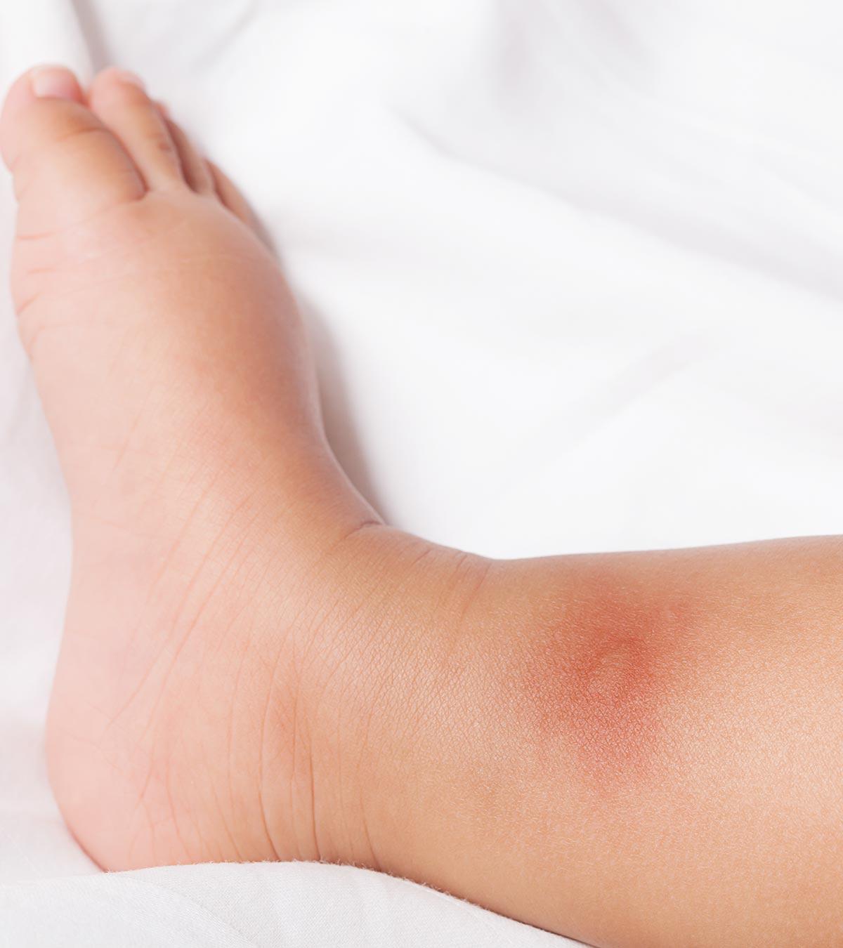 Bedbug bites on a baby