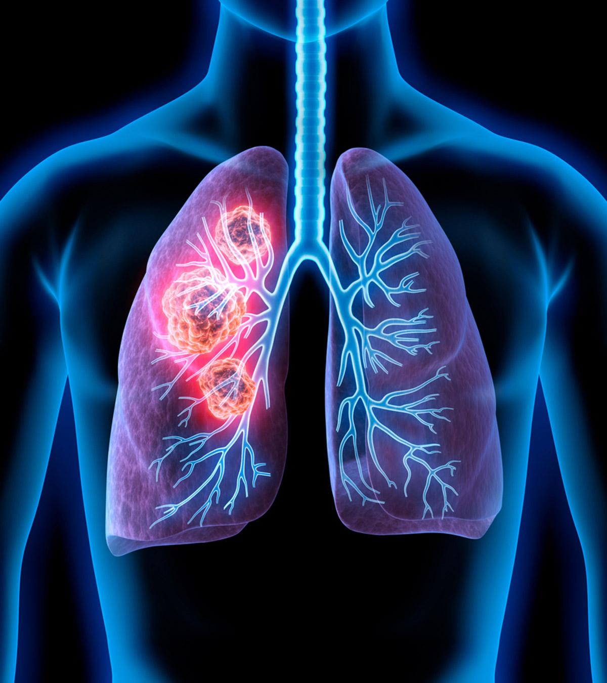 Lung cancer diagram