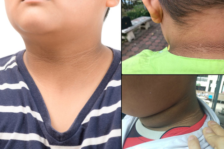 Acanthosis Nigricans In Kids Symptoms Pictures And Treatment