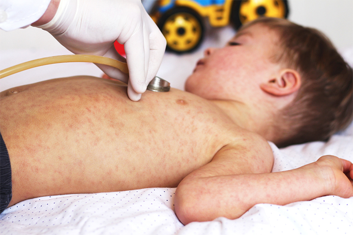 Roseola rash in toddlers begins in the chest and the stomach