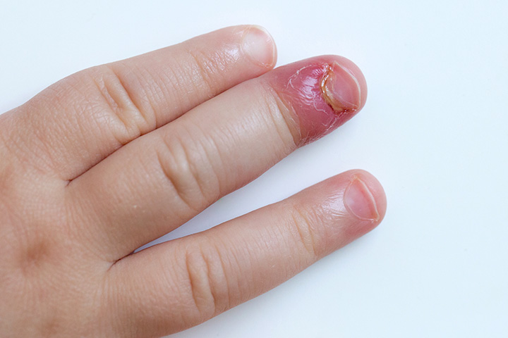 8 Signs And Symptoms Of Staph Infection In Toddlers