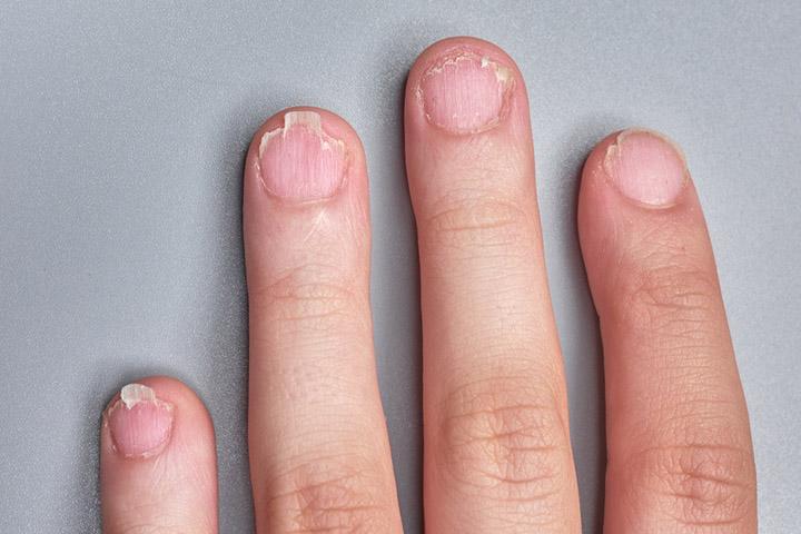 नेल फंगस (नाखून की बीमारी) के कारण, लक्षण और घरेलू इलाज - Nail Fungus  Symptoms and Home Remedies in Hindi