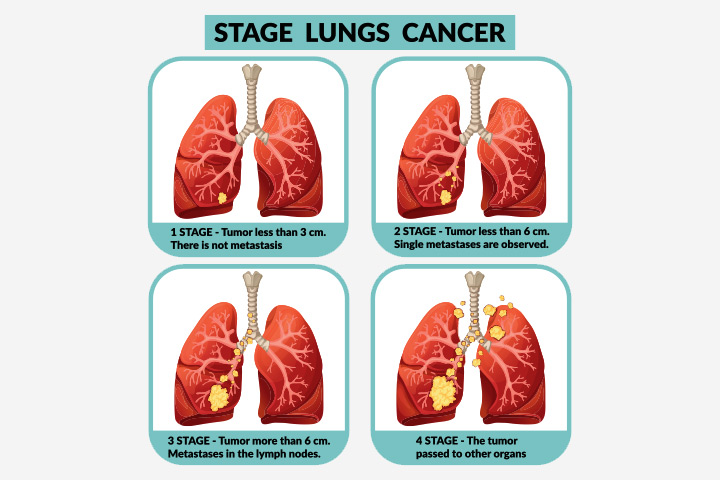 Stages of lung cancer in teenagers