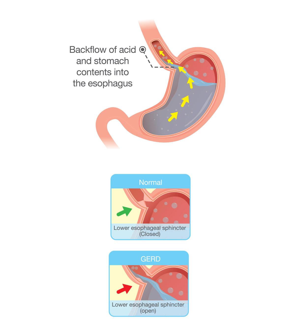 Shown acid reflux diagram