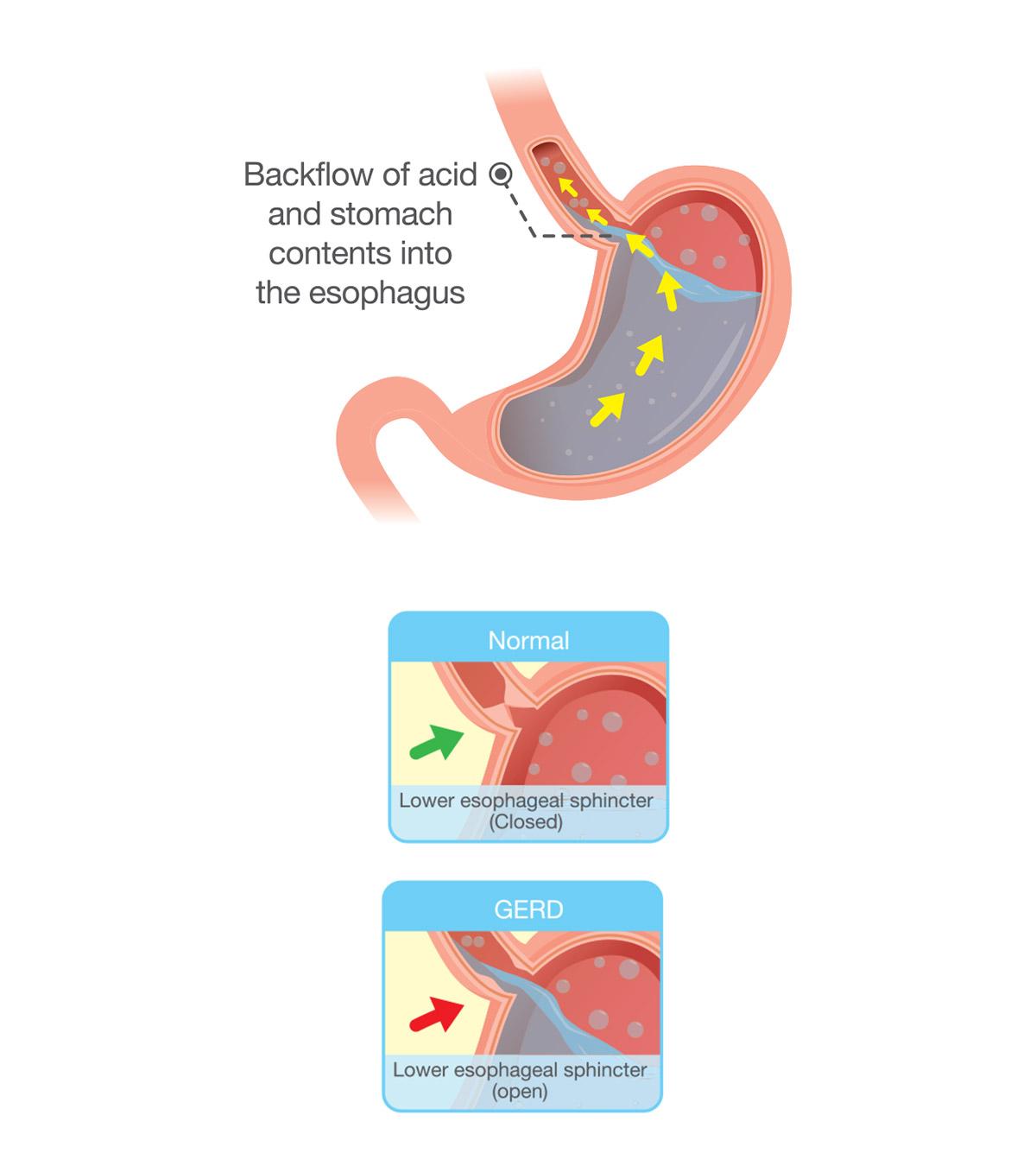 11 Common Symptoms Of Acid Reflux In Babies And Its Treatment