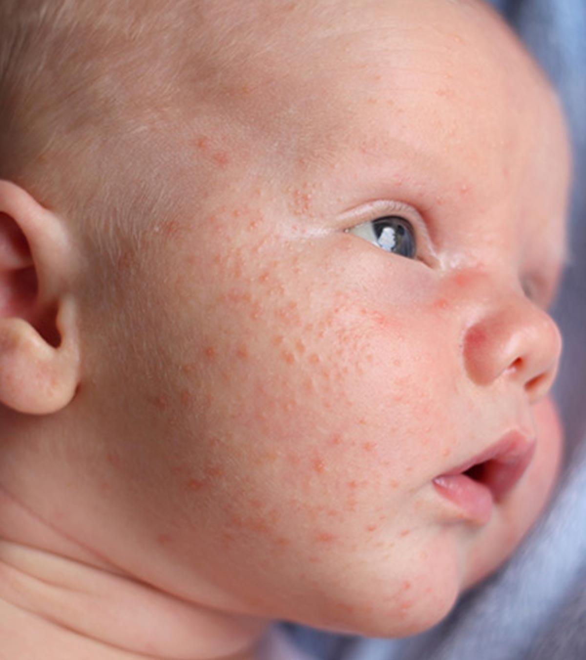 Baby Suffering From Acne