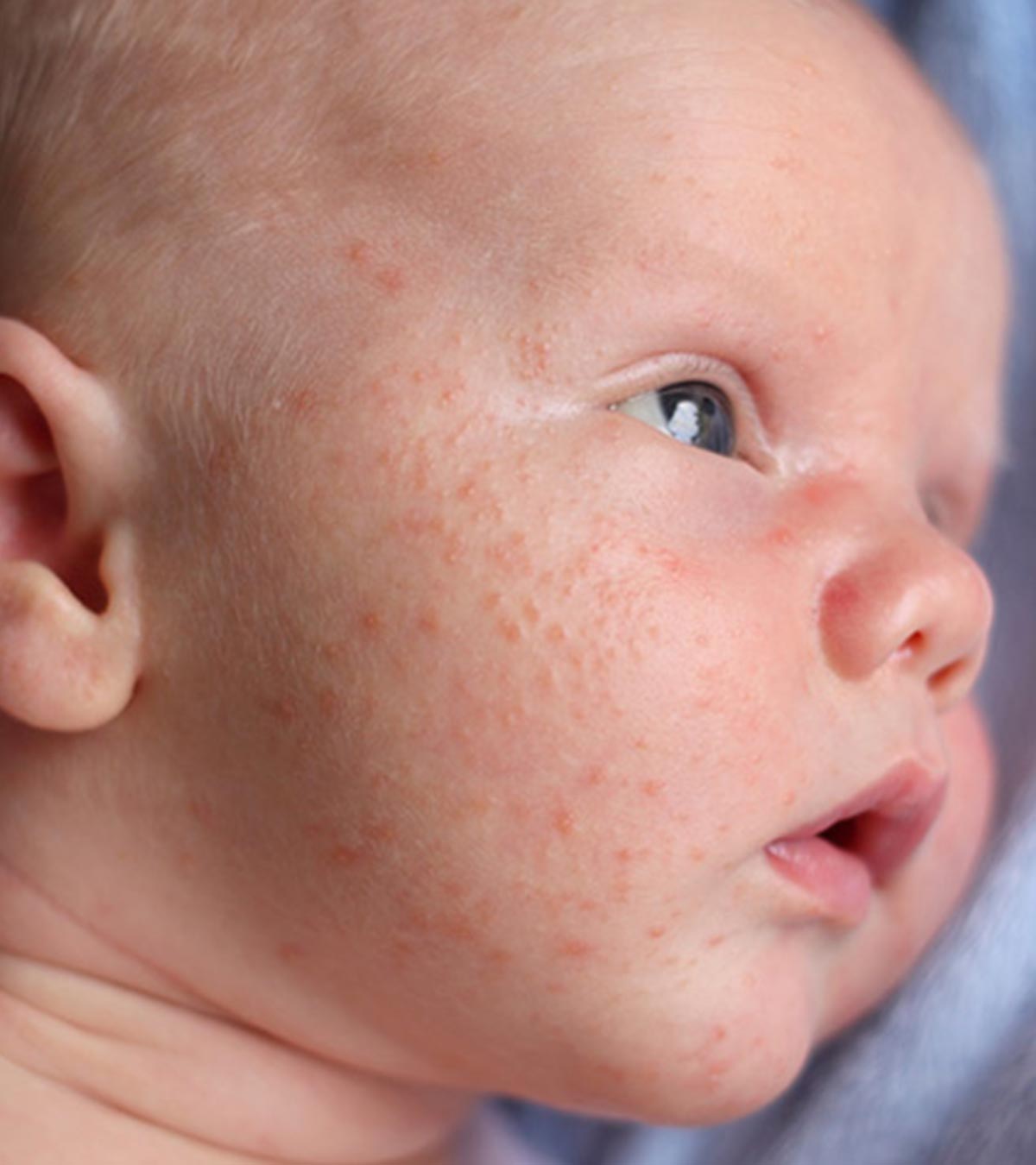 Baby Acne: Causes, Symptoms And How To Get Rid Of It