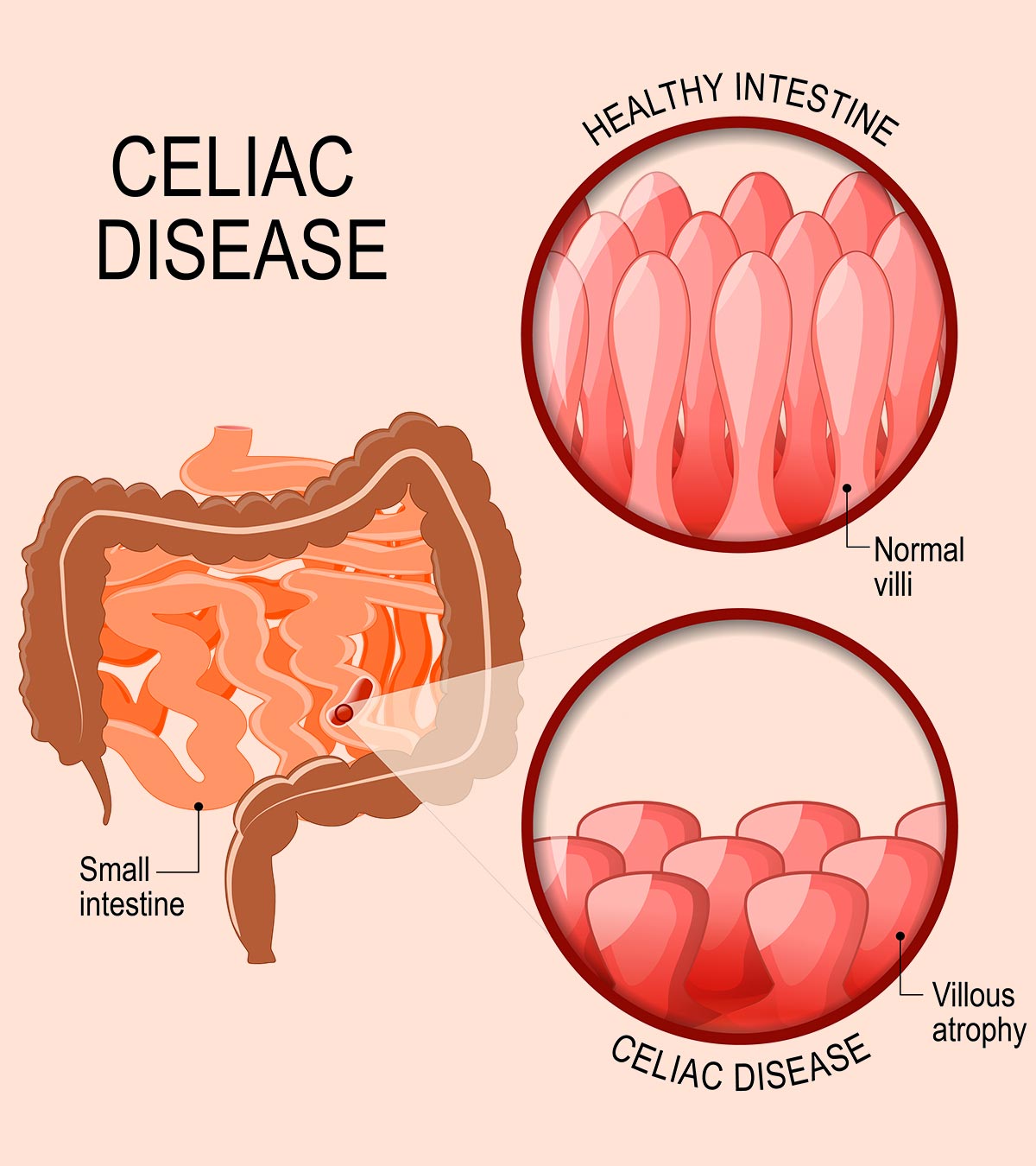 Celiac Disease In Teens: Causes, Symptoms, Treatment And Risk Factors