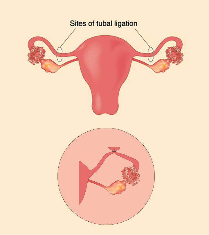Symptoms Of Pregnancy After Tubal Ligation And Risks Involved