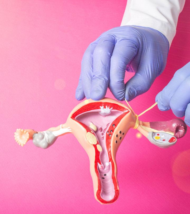Representation Of Pregnancy After Tubal Ligation