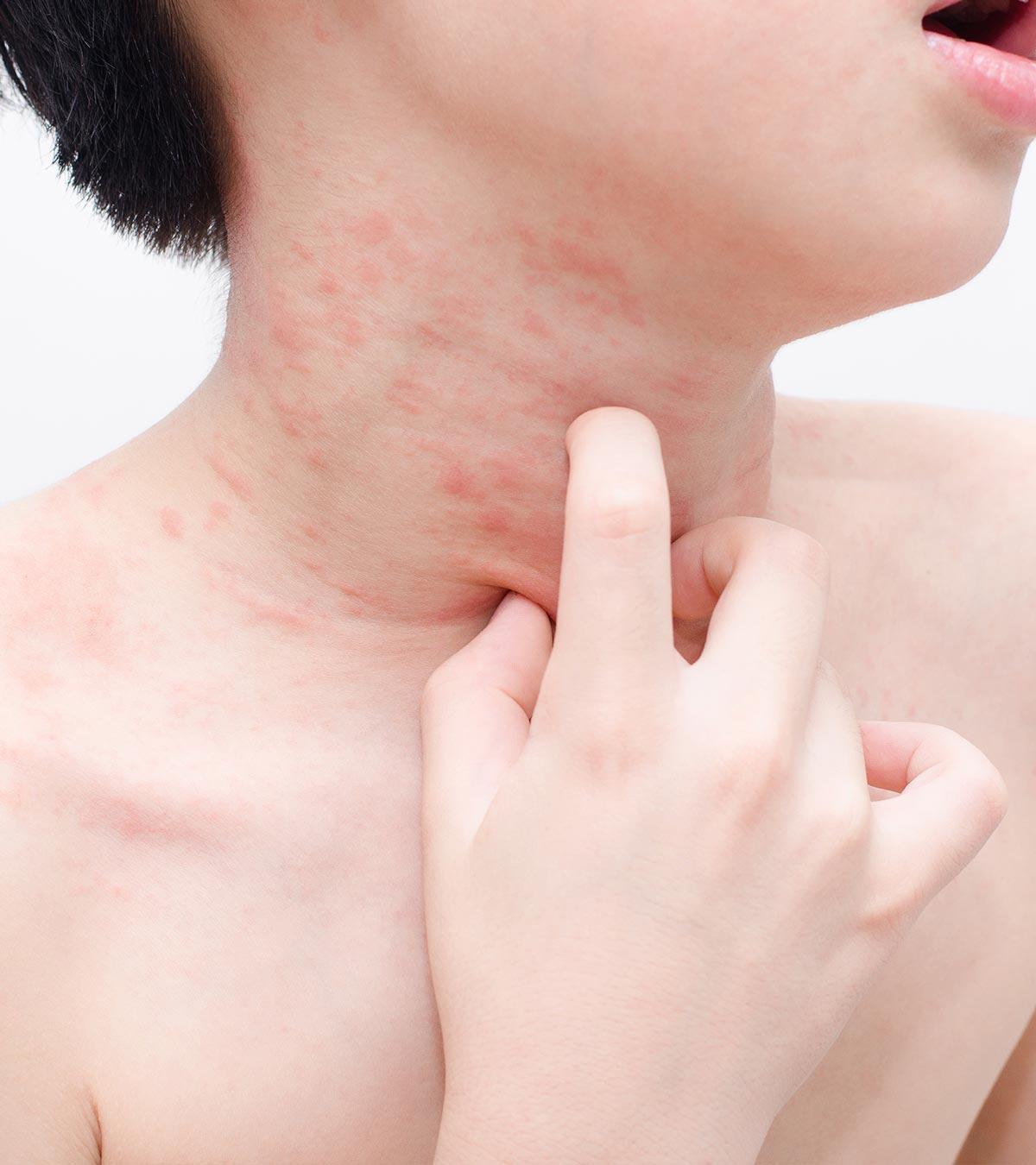 Child With Common Skin Rashes