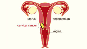 Cervical Cancer During Pregnancy - Everything You Need To Know