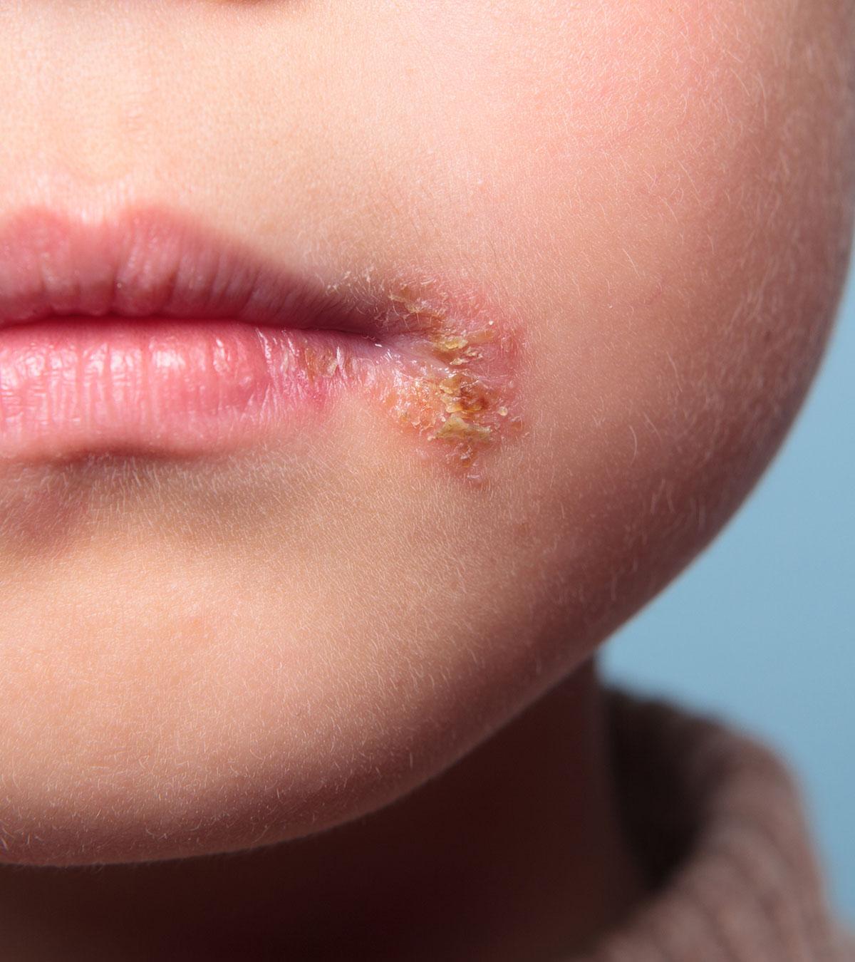 Impetigo In Children