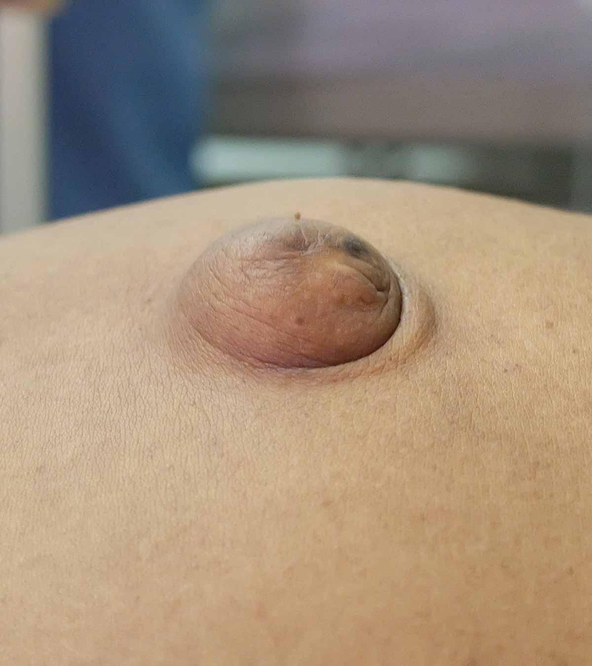 Woman With Postpartum Umbilical Hernia