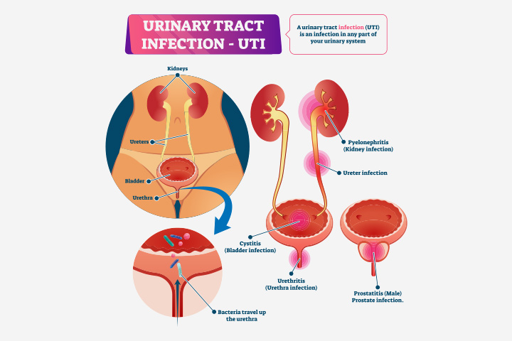 Causes Of Urinary Tract Infections In Teens
