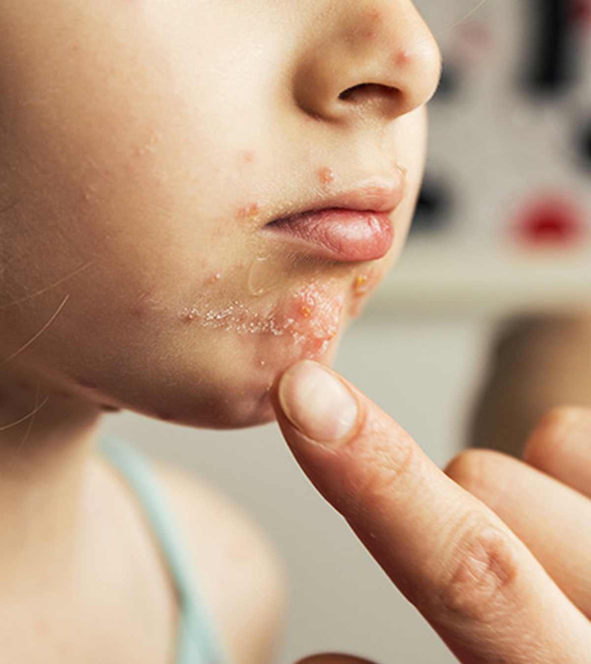 Hand Foot And Mouth Disease In Children