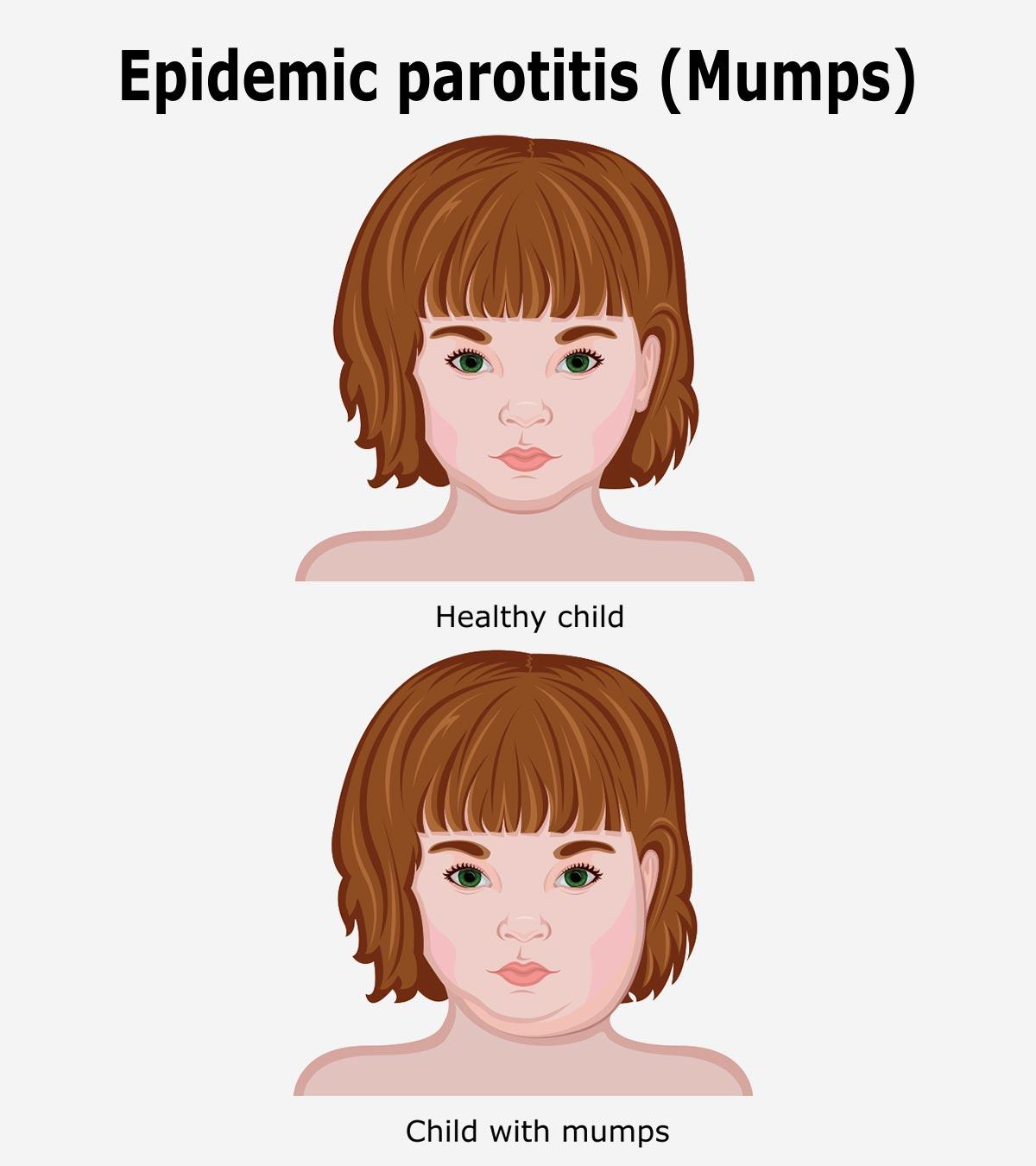 Child with mumps