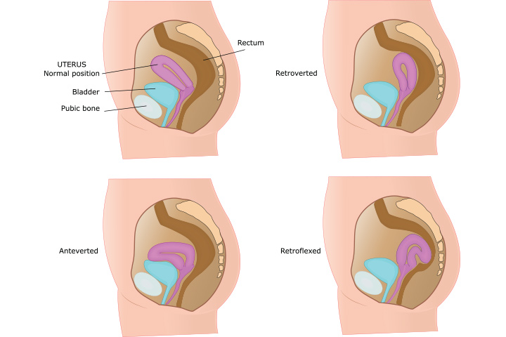 Common uterus positions during pregnancy