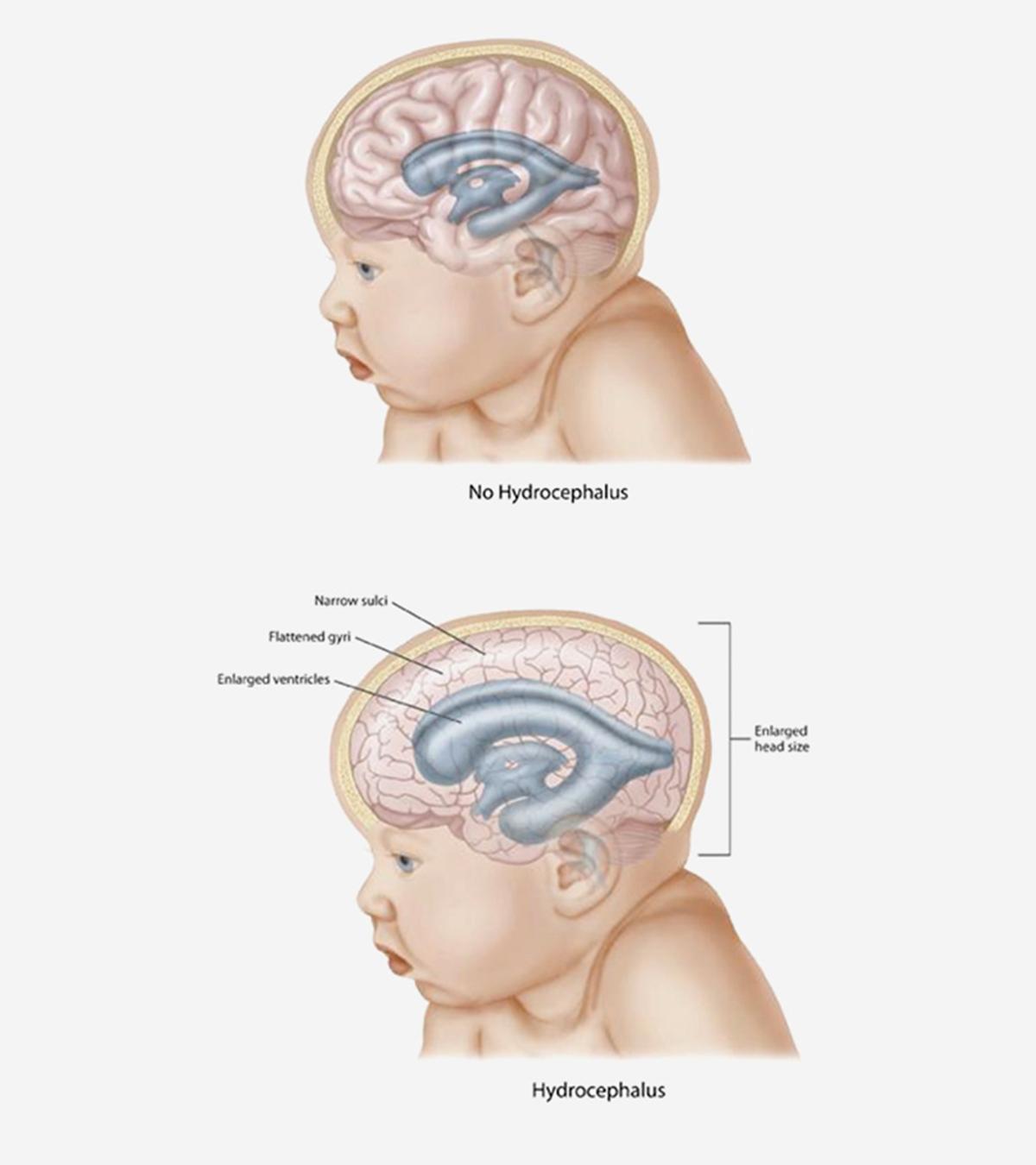 Hydrocephalus in babies