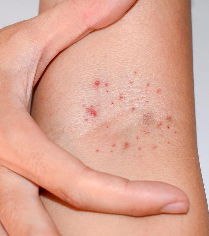 What Causes Red Spots On Skin & How To Treat Them – SkinKraft