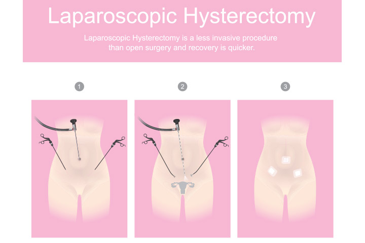 Laparoscopic is a non invasive hysterectomy procedure