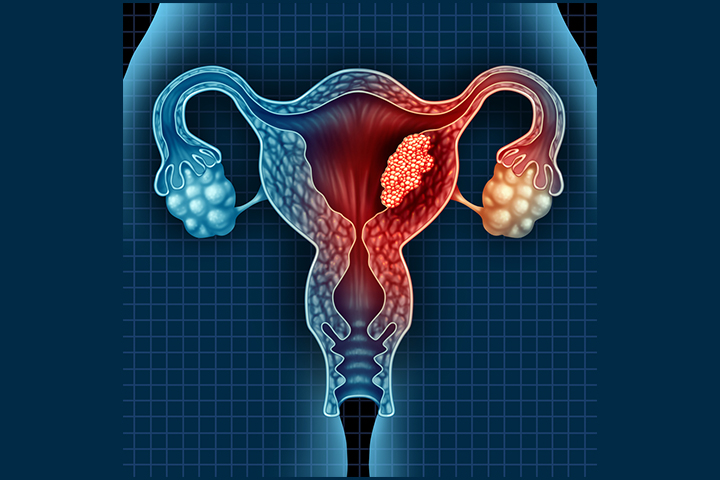 Untreatable uterine cancer may warrant the need for hysterecctomy