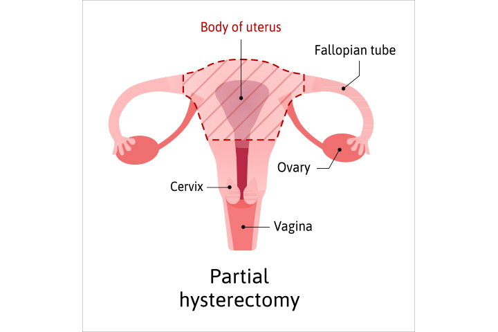 Partial hysterectomy retains the ovaries and fallopian tubes
