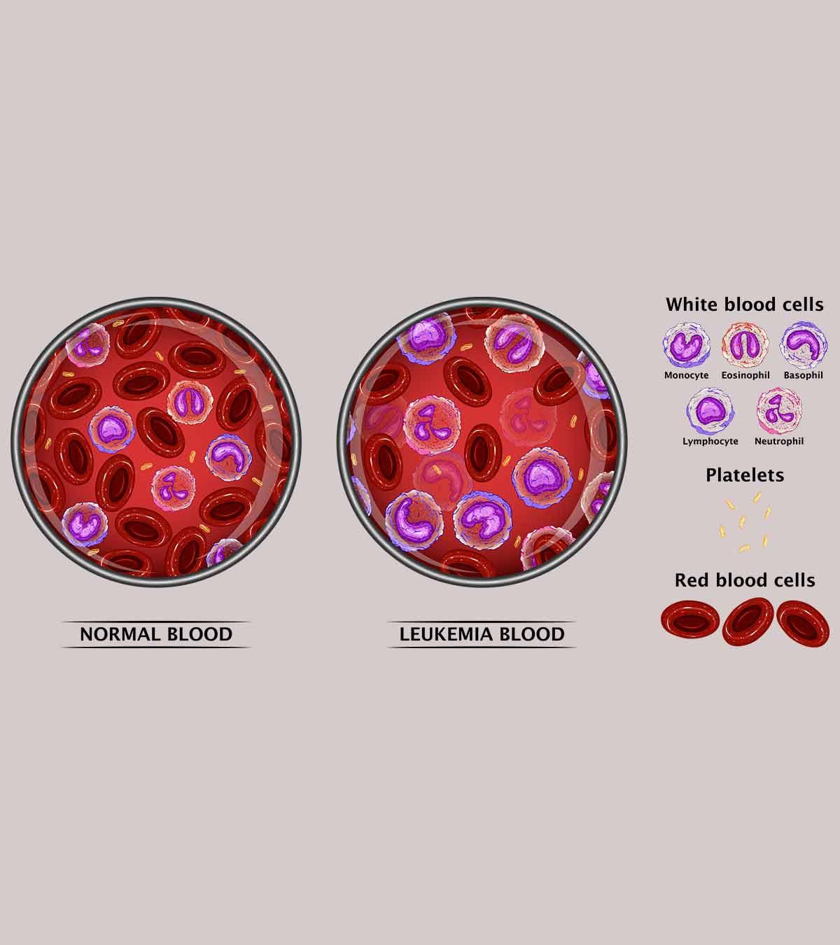 Leukemia In Teens Symptoms Treatment1