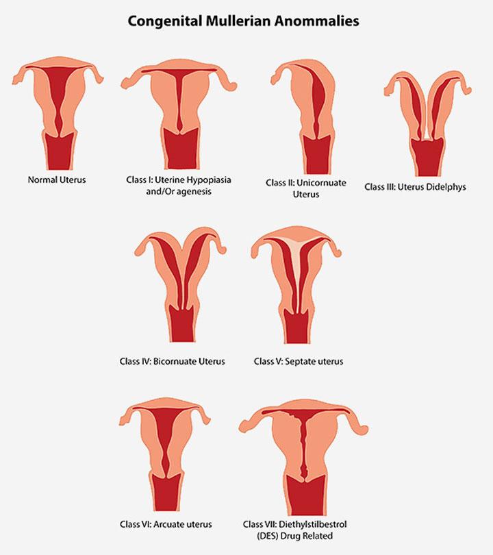 Uterine Abnormalities During Pregnancy - Classification, Symptoms & Treatment