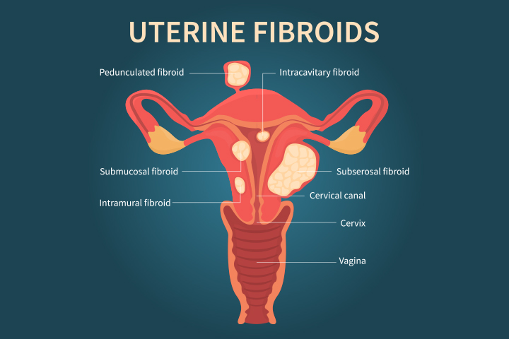 One may need hysterecony due to uterine fibroids