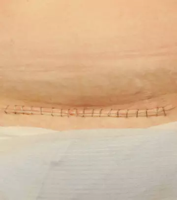 14 FAQs About C-Section Scars