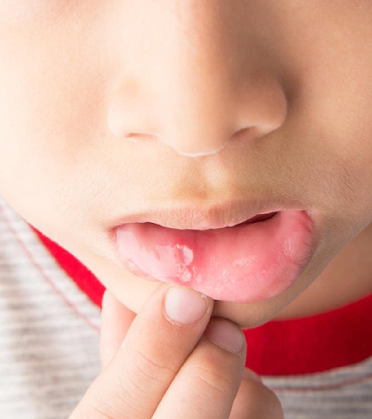 Child With Mouth Sore, Highlighting Canker Sore Information