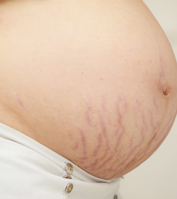 The Difference Between Red And White Stretch Marks
