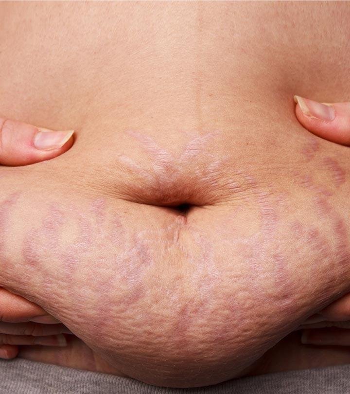 How To Use Vicks VapoRub To Get Rid Of Stretch Marks?