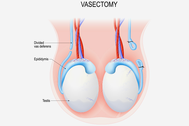Vasectomy procedure in men