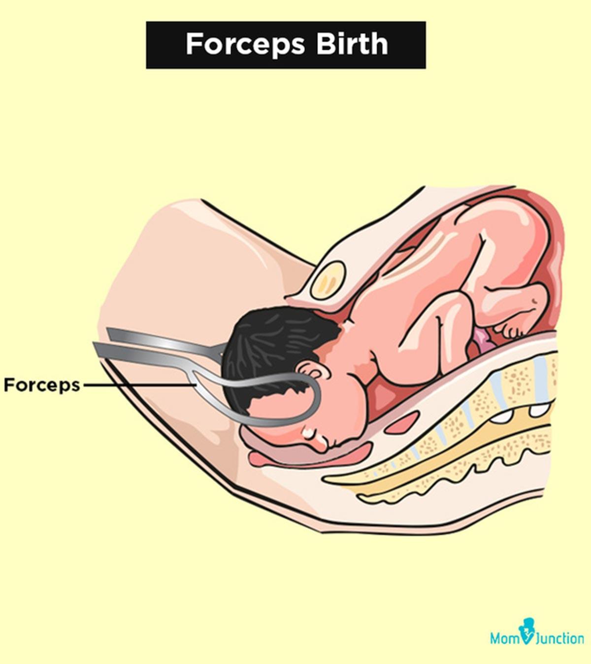 Forceps Delivery When And How Is It Done