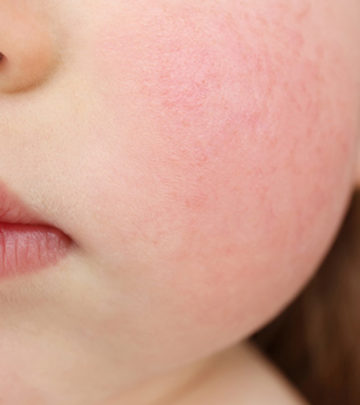 Slapped Cheek Syndrome: Everything You Need To Know About The Condition