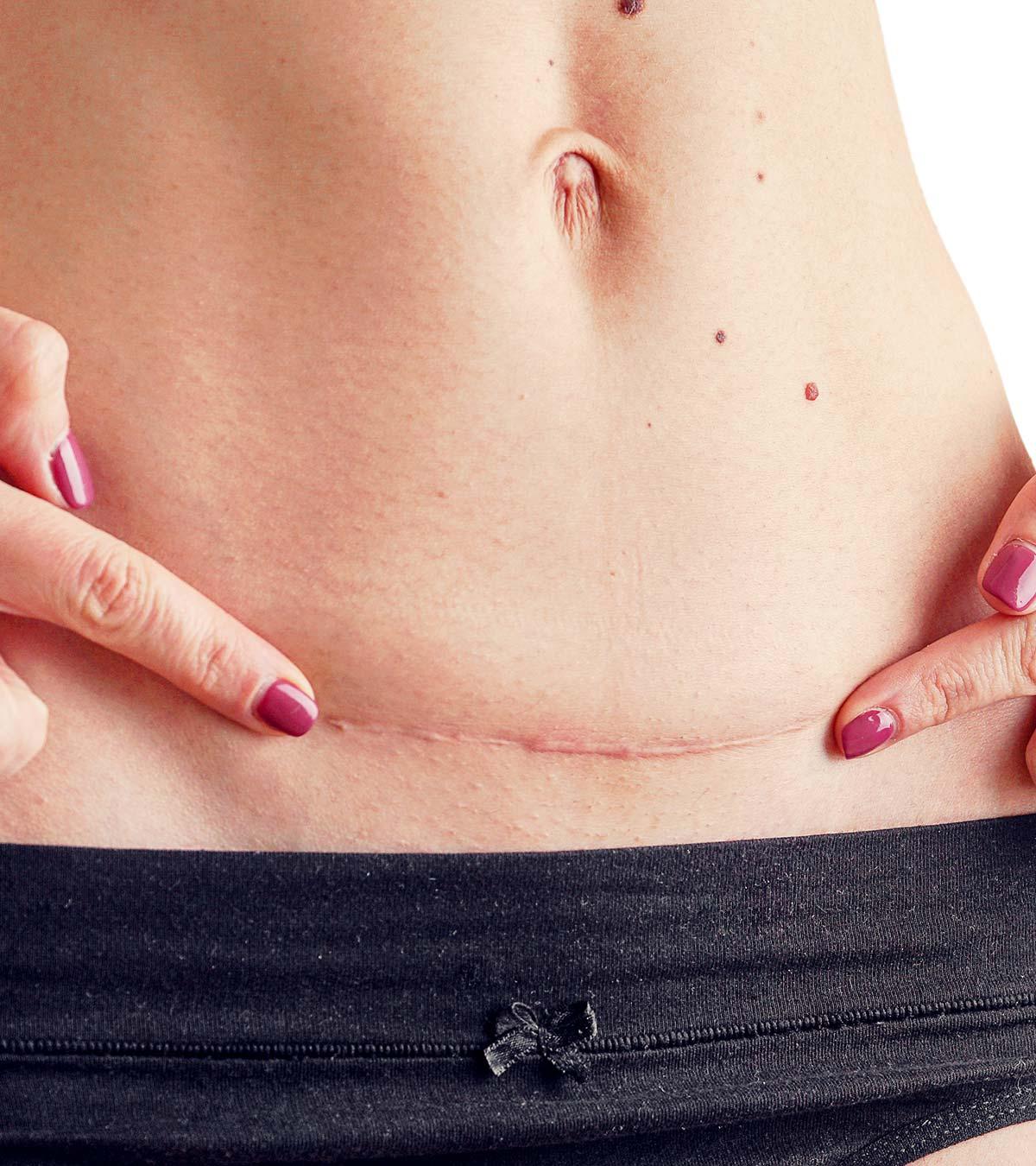A Woman With A C-section Scar