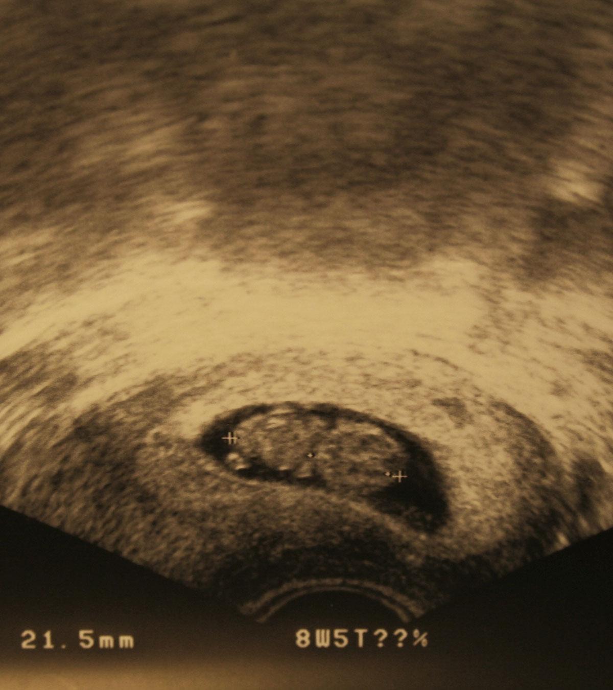 Ultrasound Image Of Baby Development