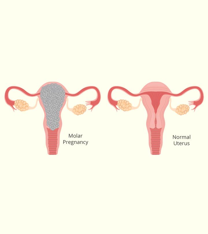 Molar pregnancy diagram