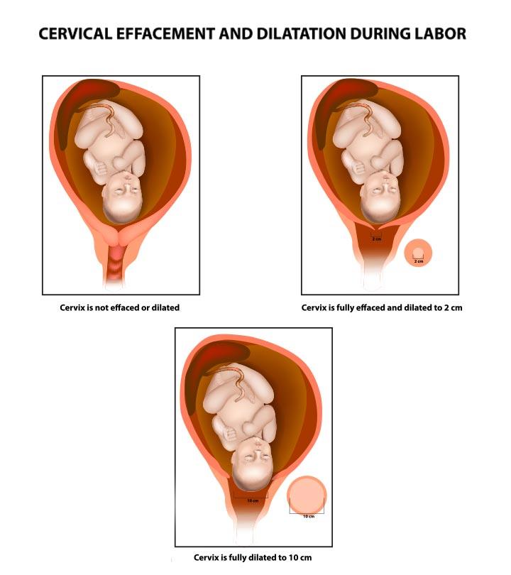 Representation Of Cervix Dilation