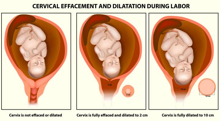 Effacement Chart