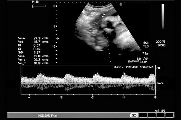 baby heartbeat during pregnancy gender