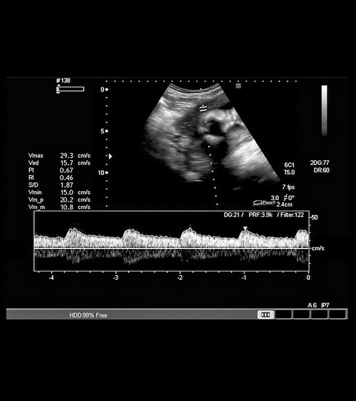 7 Week Ultrasound Heartbeat