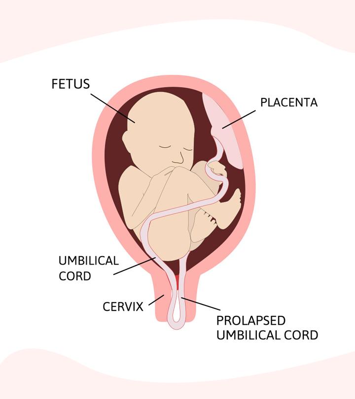 Diagram Explaining Umbilical Cord Prolapse