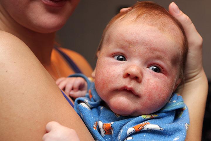 Eczema