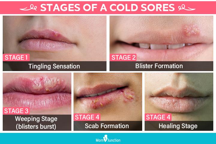 Herpes On Lips Early Stages