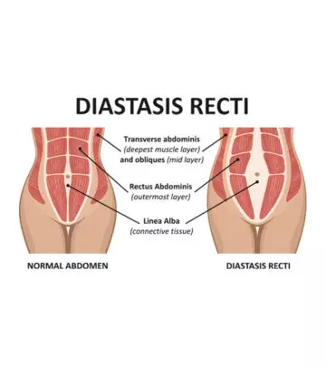 Diastasis Recti: Causes, Symptoms, Diagnosis And Treatment