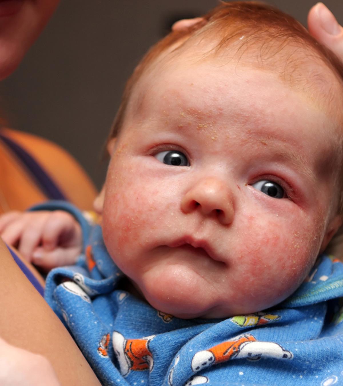 home remedies for baby eczema on face