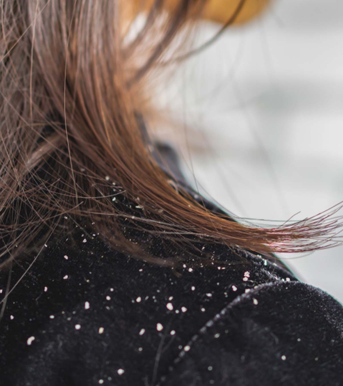 Dandruff During Pregnancy - Causes And Remedies